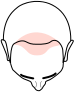 Receding Hairline